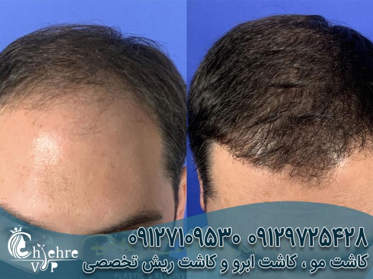 کاشت مو بدون جراحی چیست؟ دکتر بهزاد دالوند