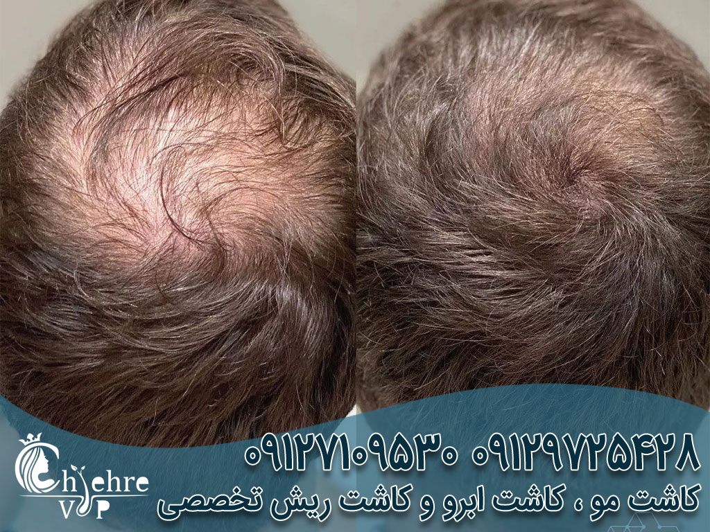 کاشت مو بدون جراحی چیست؟ دکتر بهزاد دالوند
