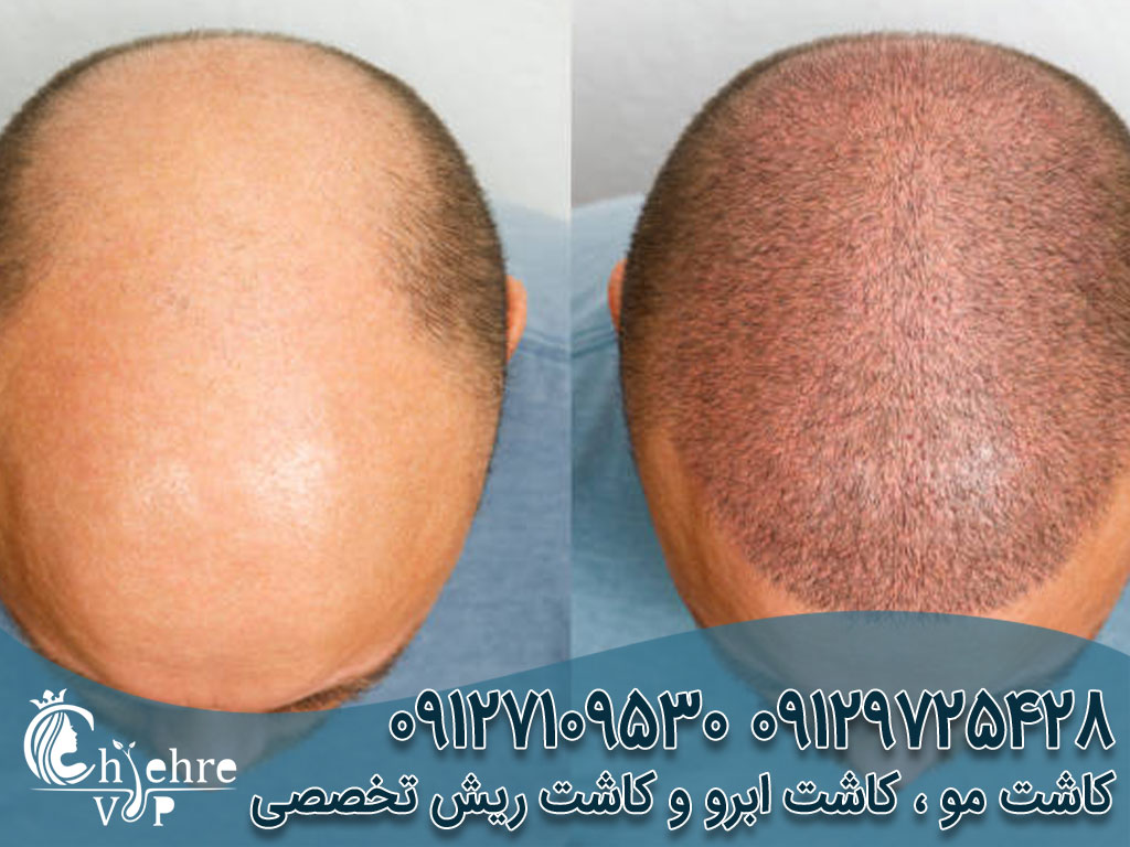 کاشت مو بدون جراحی چیست؟ دکتر بهزاد دالوند