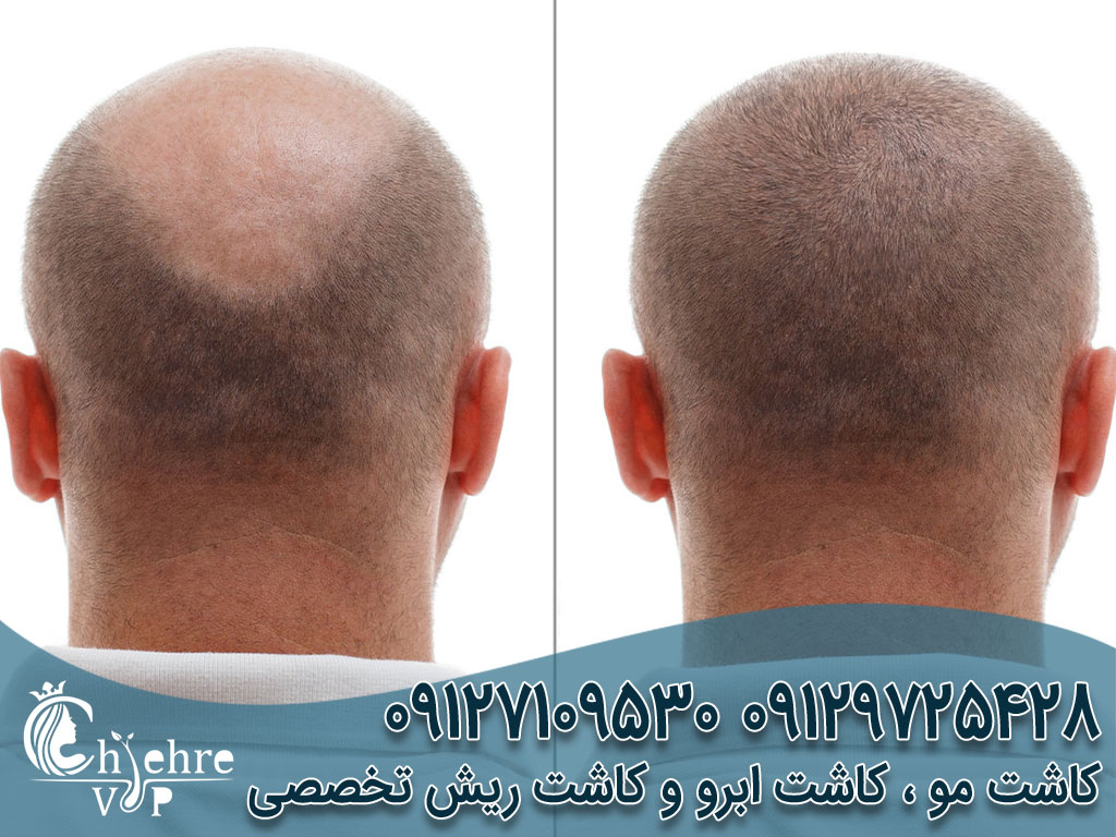 کاشت مو بدون جراحی چیست؟ دکتر بهزاد دالوند