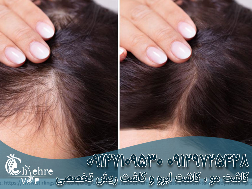 کاشت مو بدون جراحی چیست؟ دکتر بهزاد دالوند