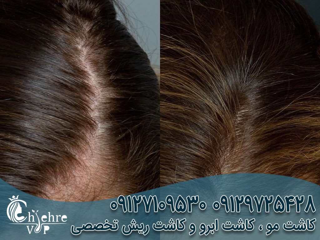 کاشت مو بدون جراحی چیست؟ دکتر بهزاد دالوند